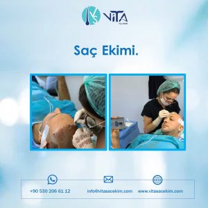 Saç Ekimi Operasyonu Öncesinde Hangi Kontroller Yapılır?