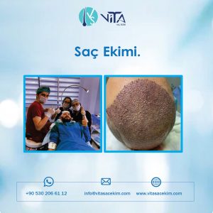 Hangi Hastalıklara Sahip Kişilere Saç Ekimi Yapılmaz?