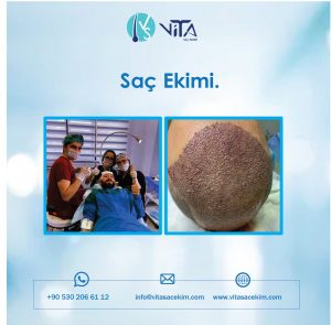 Saçların İnce Telli Olması Saç Ekimi Operasyonunu Etkiler mi